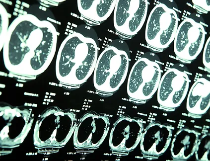 Brain injury.webp